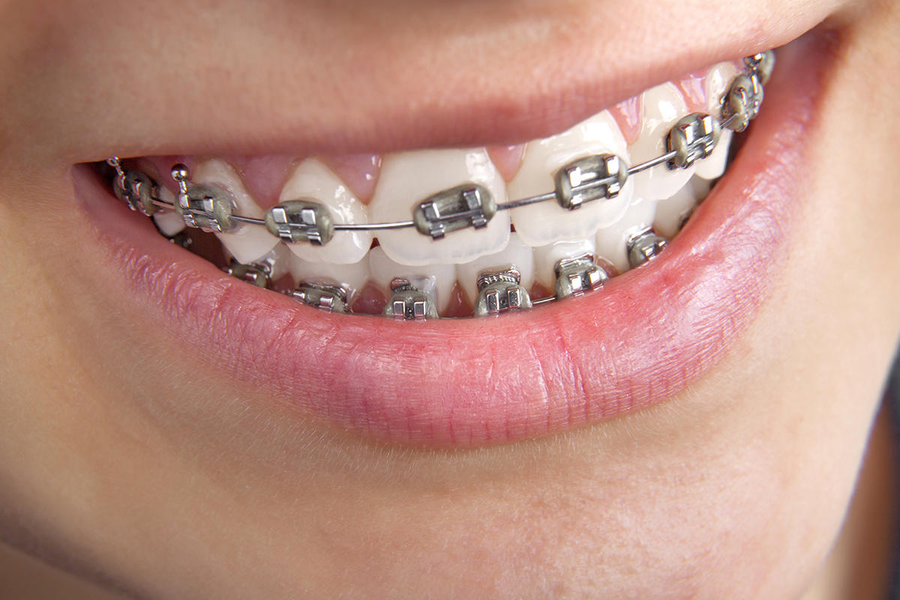 Bond strength and brackets: to etch or not to etch?