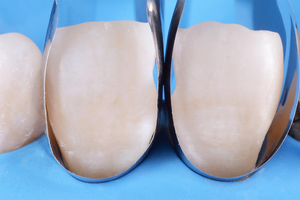 Unica Anterior Sectional Matrix System