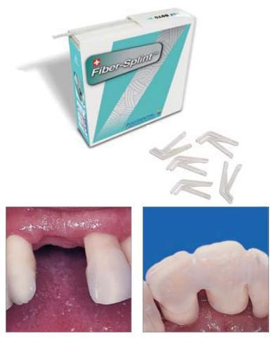 Clip&Splint 30 (Polydentia) Clip&Splint 30 (Polydentia)