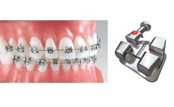 Brackets